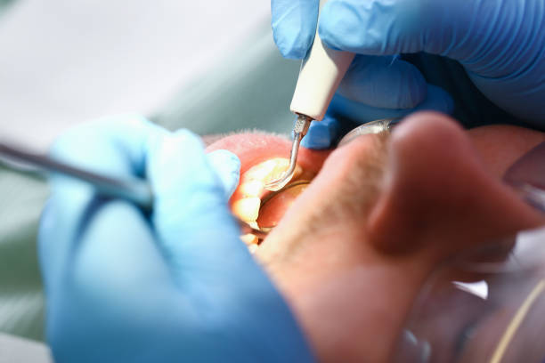 Best Emergency Dental Care for Abscessed Tooth in Shawsville, VA